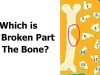 Which is The Broken Part of The Bone?